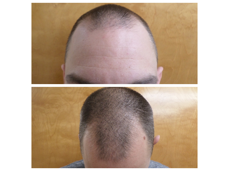 The Advantages of Hair Transplantation in New York