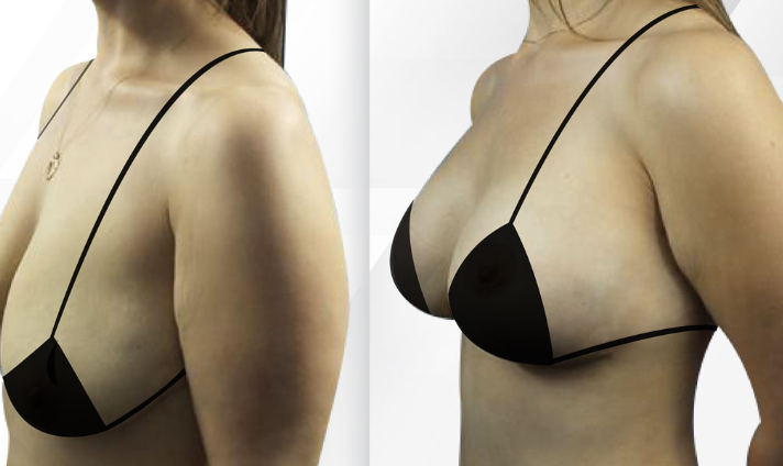 Breast implants Miami surgery offers many benefits that can help women feel more confident and beautiful