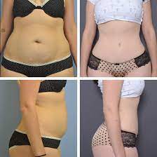How Much Does Abdominoplasty Cost in Miami?