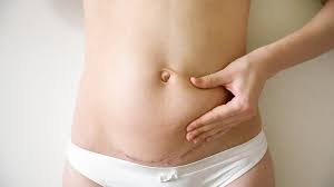 Miami’s Reputation for Top-Class Tummy Tuck Services